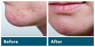 Cystic Acne